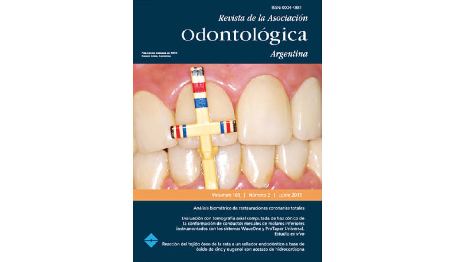 Evaluación con tomografía axial computada  de haz cónico de la conformación de conductos  mesiales de molares inferiores instrumentados  con los sistemas WaveOne y ProTaper Universal. Estudio ex vivo