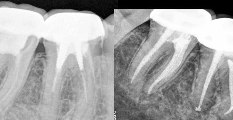 Endodontic retreatment: a conservative and predictable therapy