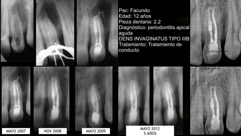 Non-surgical endodontic treatment of a maxillary lateral incisor with dens invaginatus: A case report