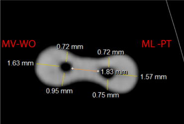 Evaluación con tomografía axial computada de haz cónico de la conformación de conductos mesiales de molares inferiores instrumentados con los sistemas WaveOne y ProTaper Universal. Estudio ex vivo