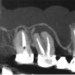 Effects of Endodontic Infections on the Maxillary Sinus: A Case Series of Treatment Outcome