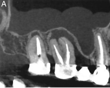 Effects of Endodontic Infections on the Maxillary Sinus: A Case Series of Treatment Outcome