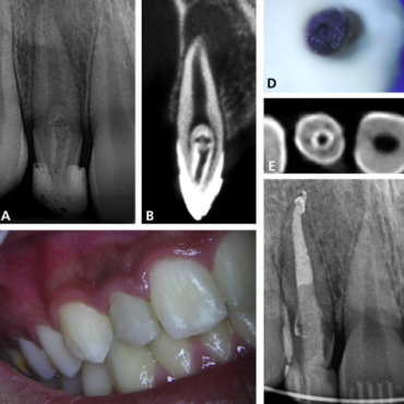 Effect of Heat Generated by Endodontic Obturation Techniques on Bond Strength of Bioceramic Sealers to Dentine