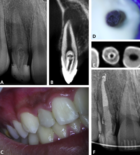 Management of teeth with dens invaginatus and apical periodontitis